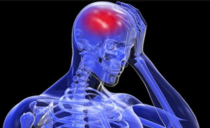 Stroke
