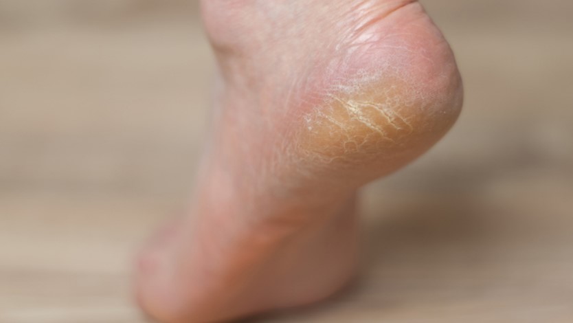 8 Cara Menghilangkan Kapalan di Kaki, Efektif untuk Dicoba!