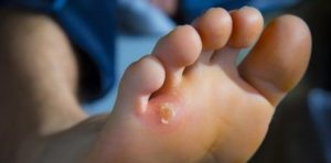 8 Cara Menghilangkan Kapalan di Kaki, Efektif untuk Dicoba!