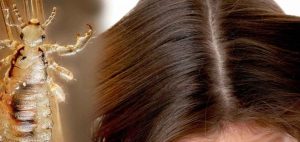 13 Cara Menghilangkan Kutu Rambut yang Ampuh!
