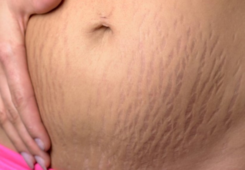 14 Cara menghilangkan stretch mark setelah melahirkan secara alami