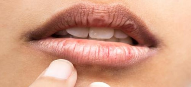 11 Cara Mengatasi Bibir Kering yang Bisa Dicoba Agar Lebih Sehat