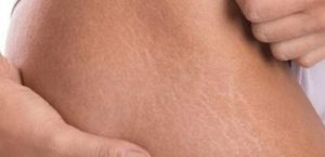 14 Cara Menghilangkan Stretch Mark Secara Alami Sampai Tuntas!