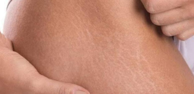 14 Cara Menghilangkan Stretch Mark Secara Alami Sampai Tuntas!