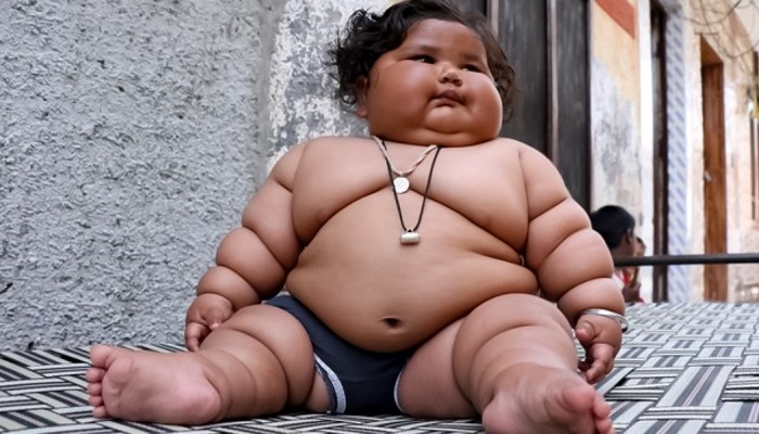 Obesitas Anak
