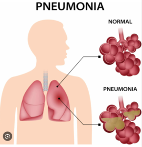 Pneumonia