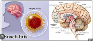 Ensefalitis